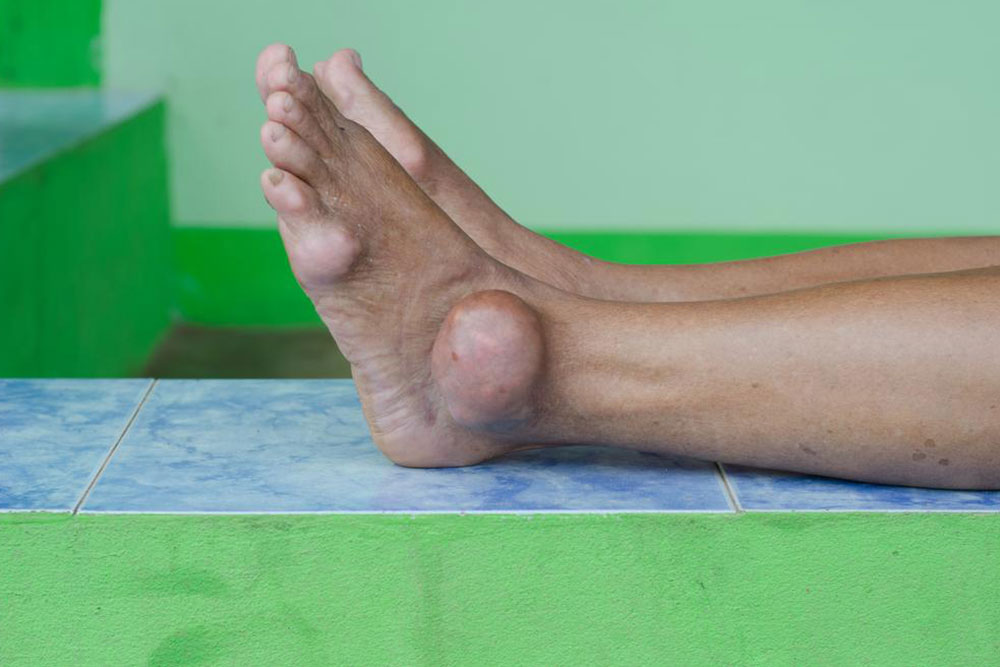 Gout attacks and their treatment procedures